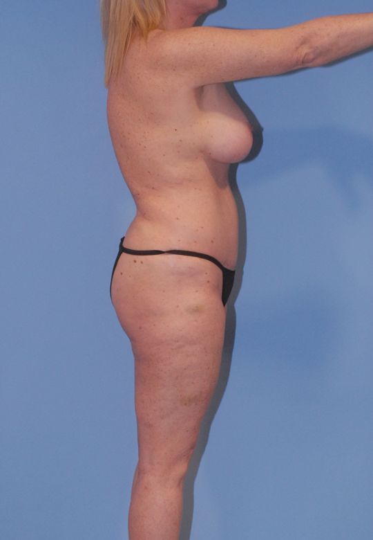 Fortes Figure Before & After