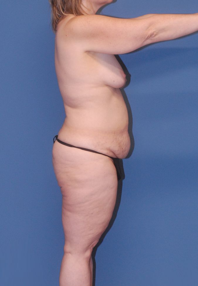 Fortes Figure Before & After