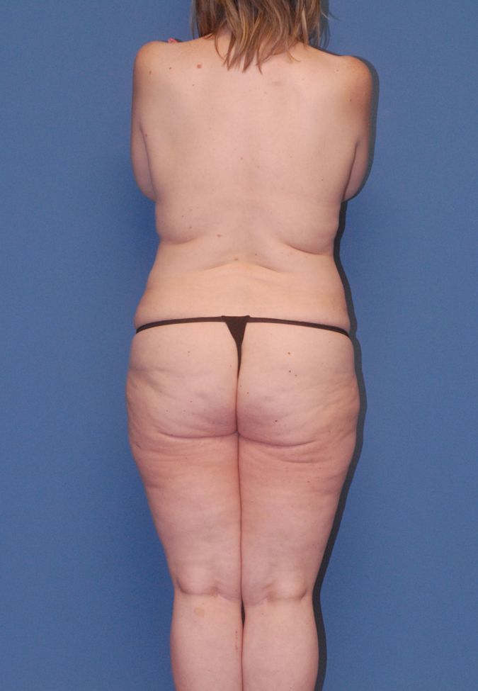 Fortes Figure Before & After