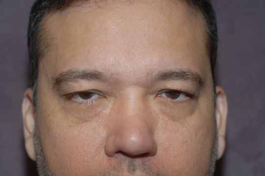 Blepharoplasty Before & After