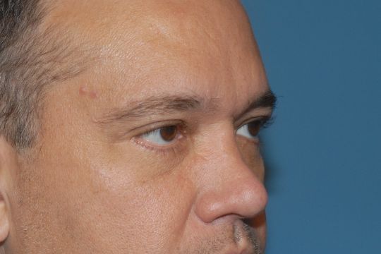 Blepharoplasty Before & After