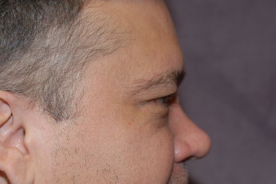 Blepharoplasty Before & After