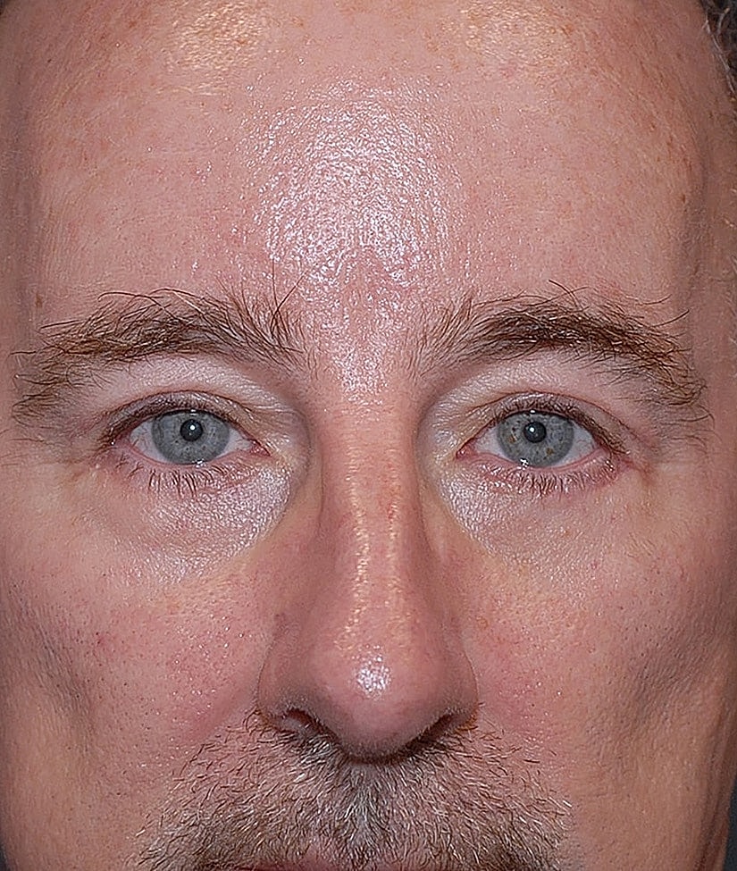 Male Blepharoplasty Before & After