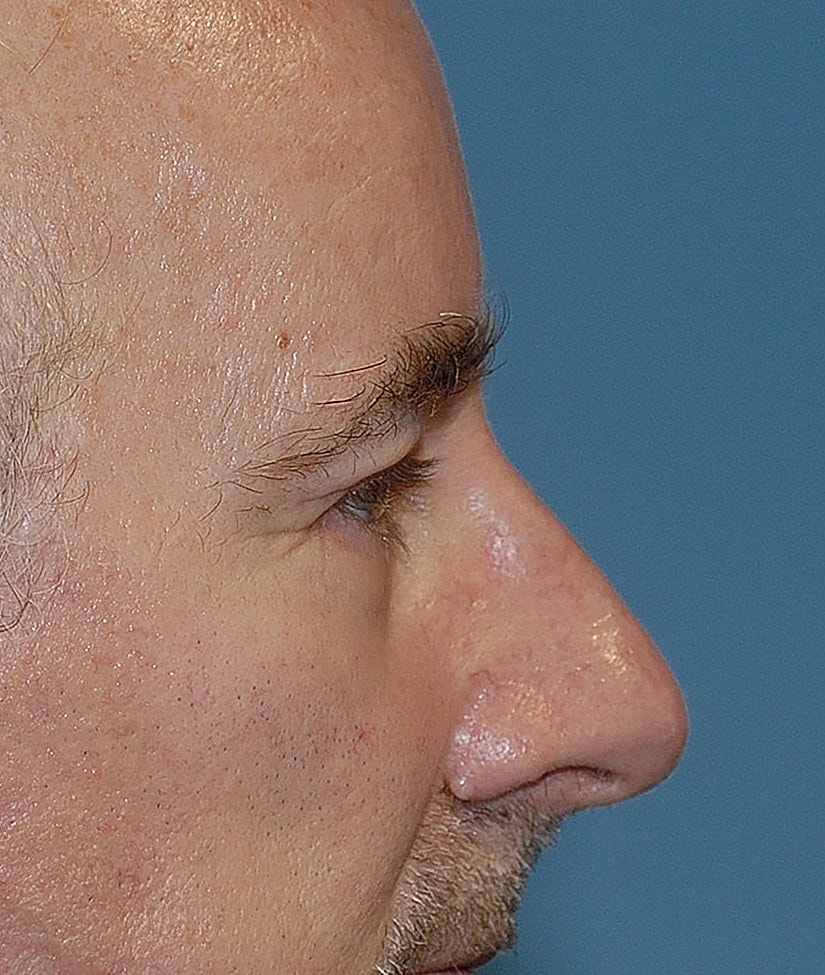 Male Blepharoplasty Before & After