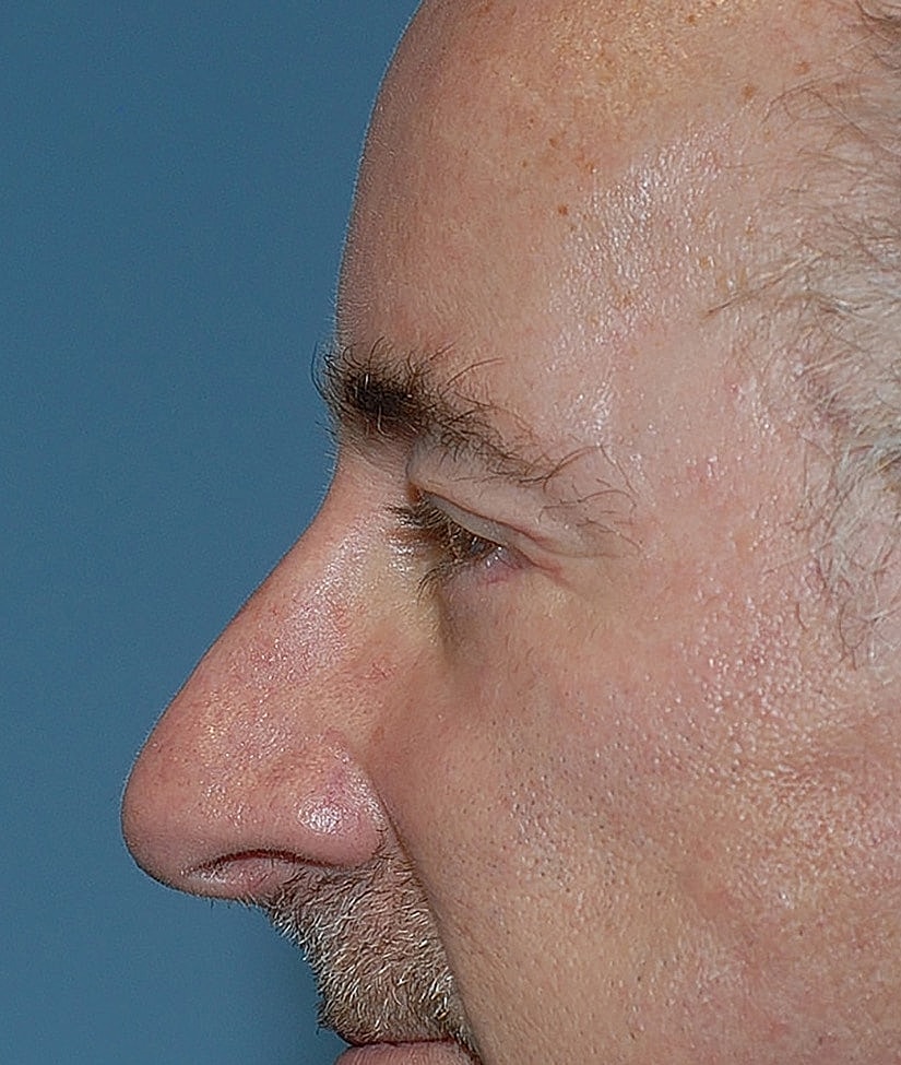 Male Blepharoplasty Before & After