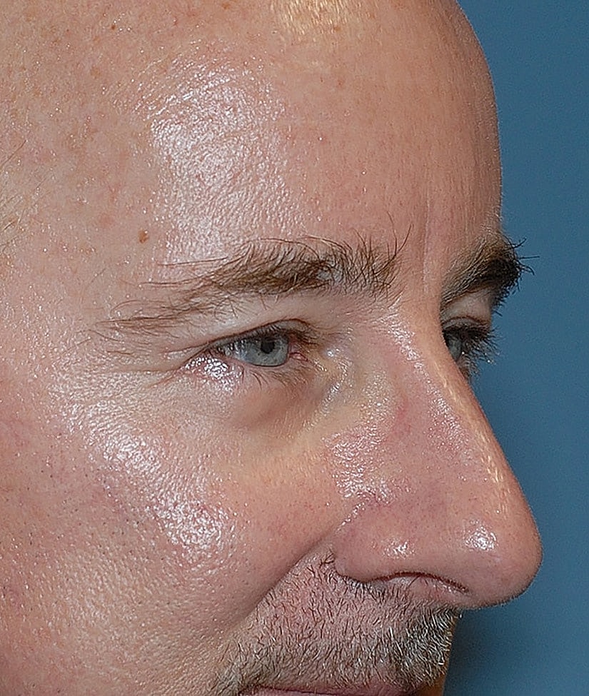 Male Blepharoplasty Before & After