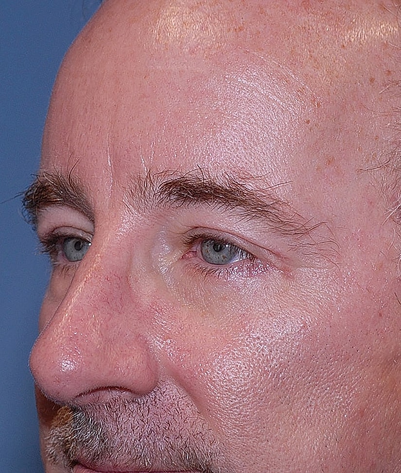Male Blepharoplasty Before & After