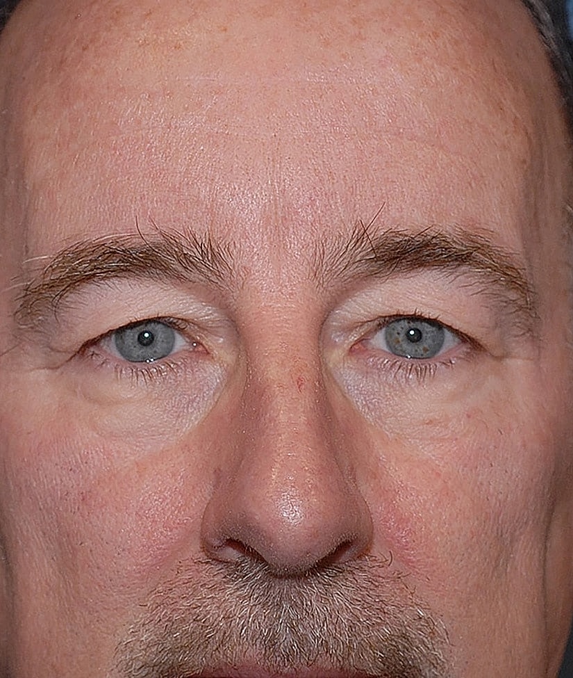 Male Blepharoplasty Before & After