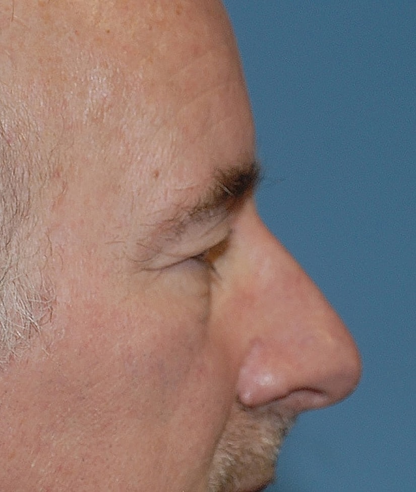 Male Blepharoplasty Before & After