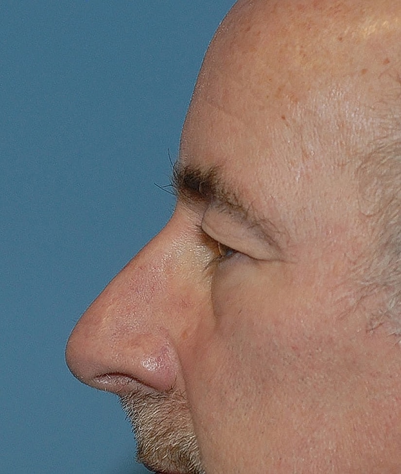 Male Blepharoplasty Before & After