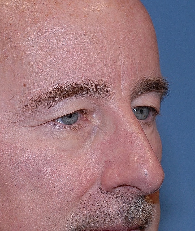 Male Blepharoplasty Before & After