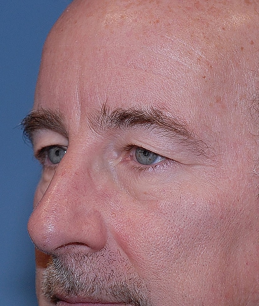 Male Blepharoplasty Before & After