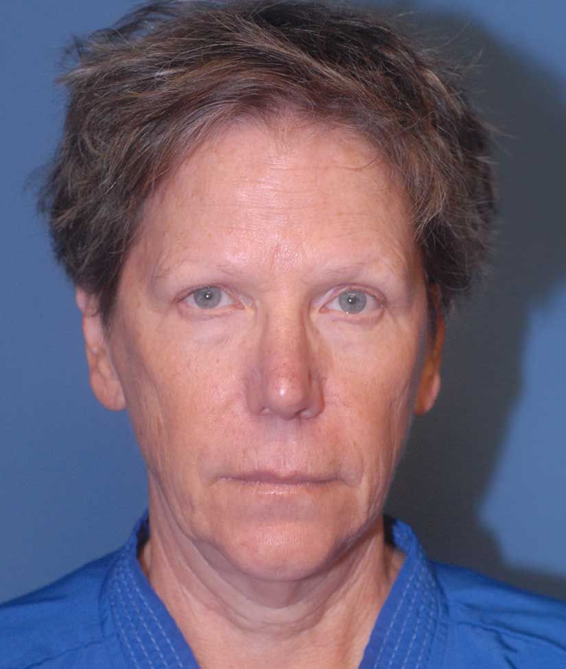 Female Facial Rejuvenation Before & After