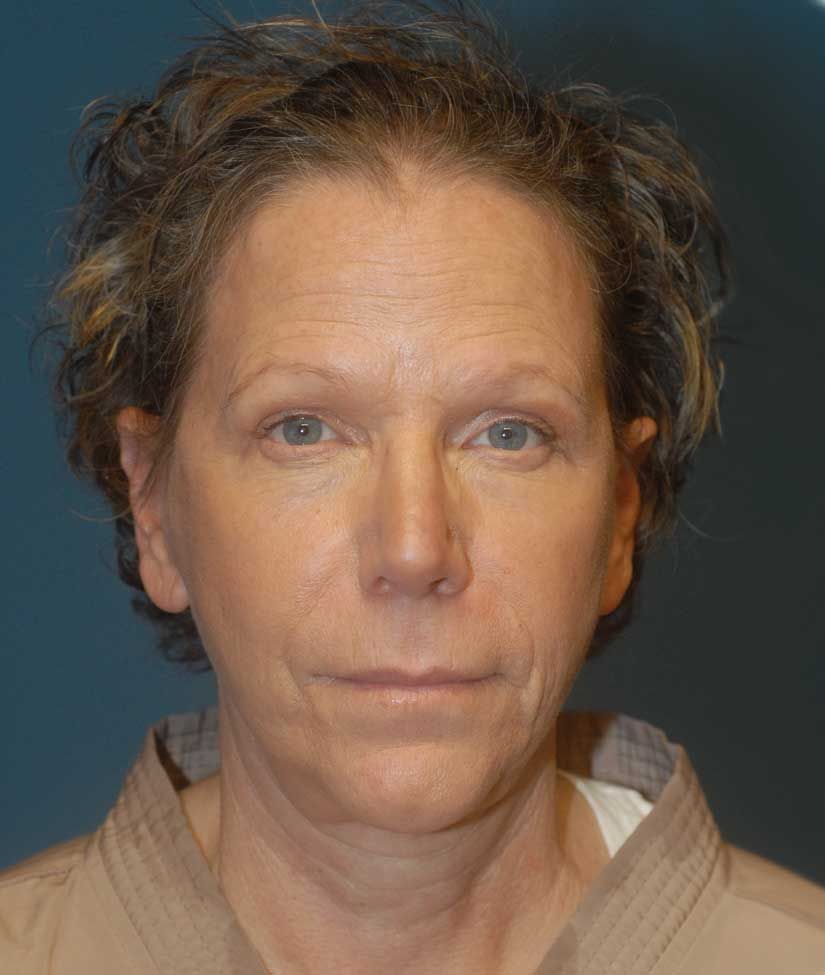 Female Facial Rejuvenation Before & After