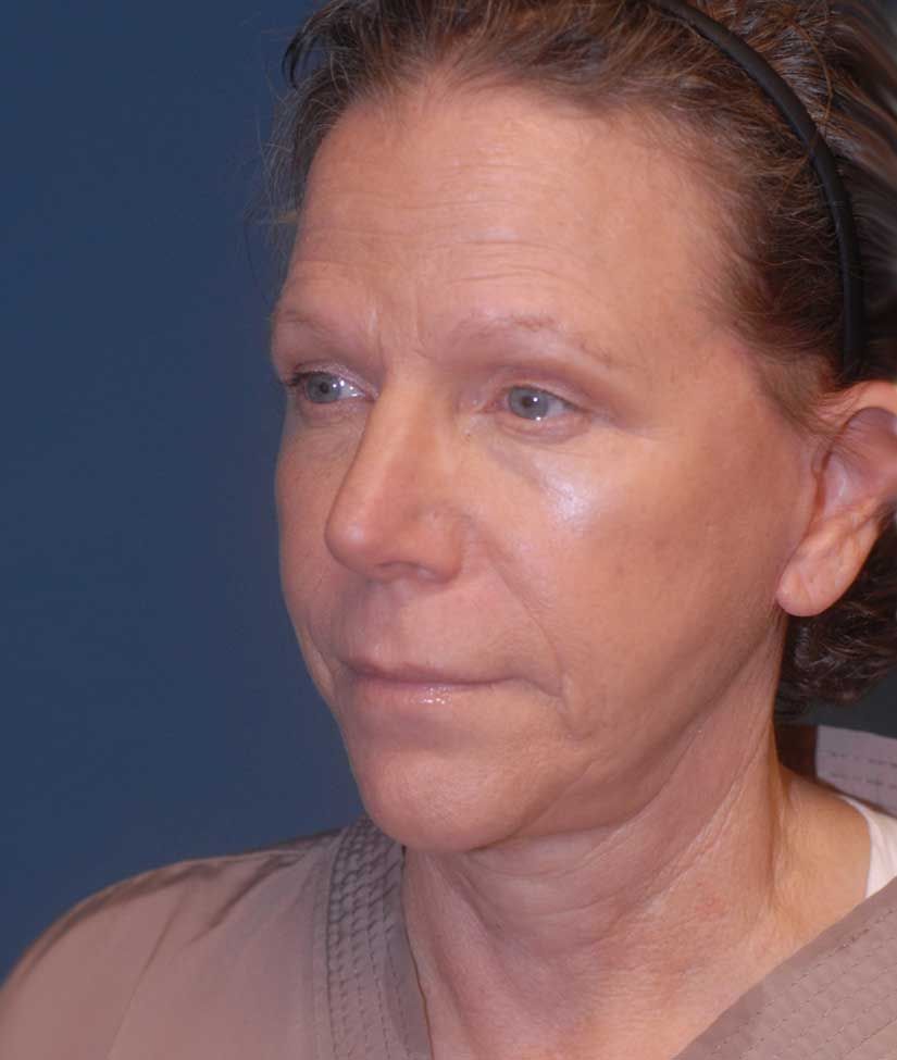 Female Facial Rejuvenation Before & After