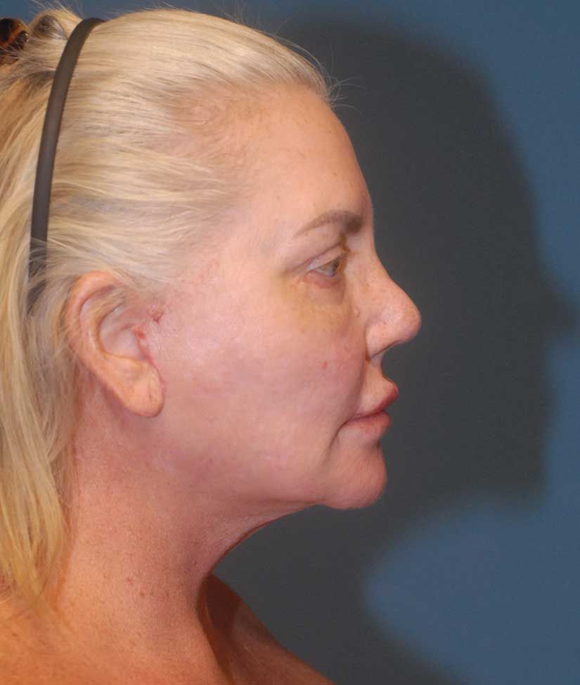 Female Facial Rejuvenation Before & After