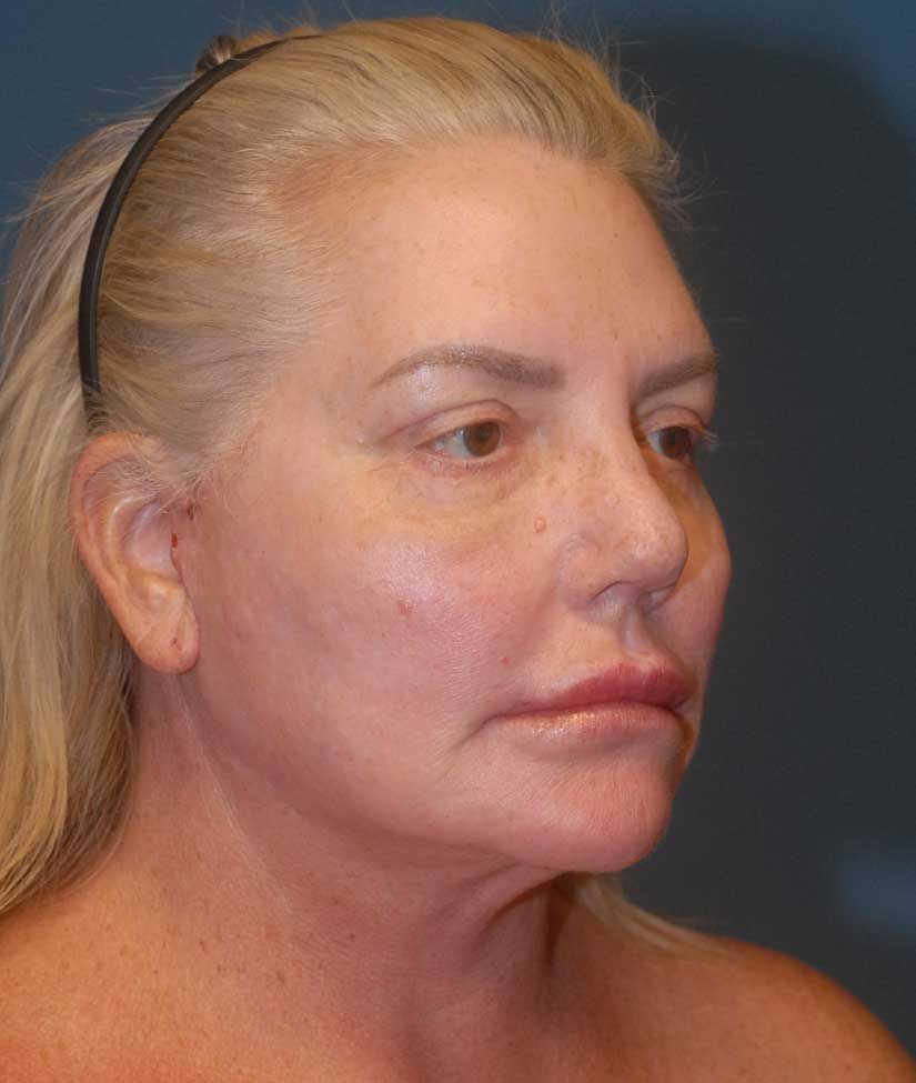 Female Facial Rejuvenation Before & After