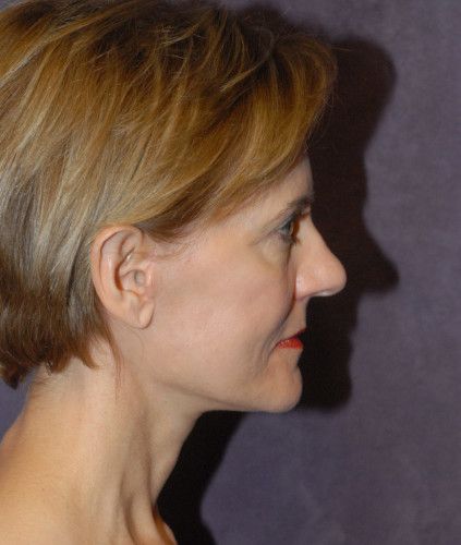 Female Facial Rejuvenation Before & After