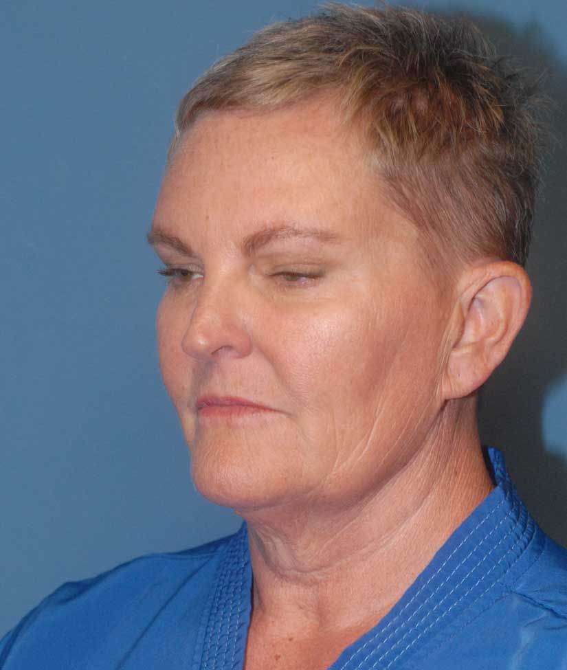 Female Facial Rejuvenation Before & After