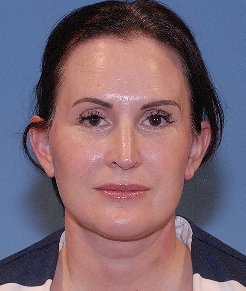 Female Facial Rejuvenation Before & After