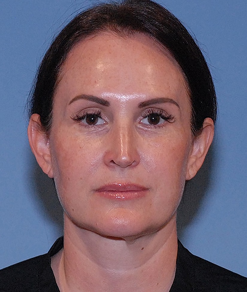 Female Facial Rejuvenation Before & After