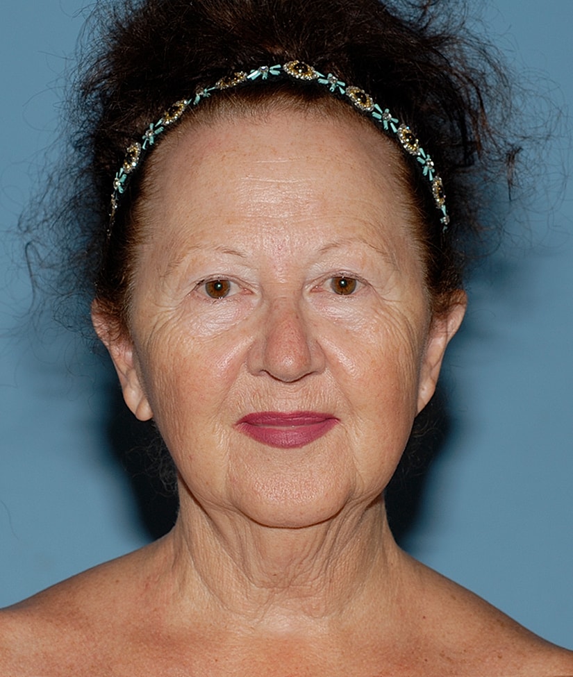 Female Facial Rejuvenation Before & After