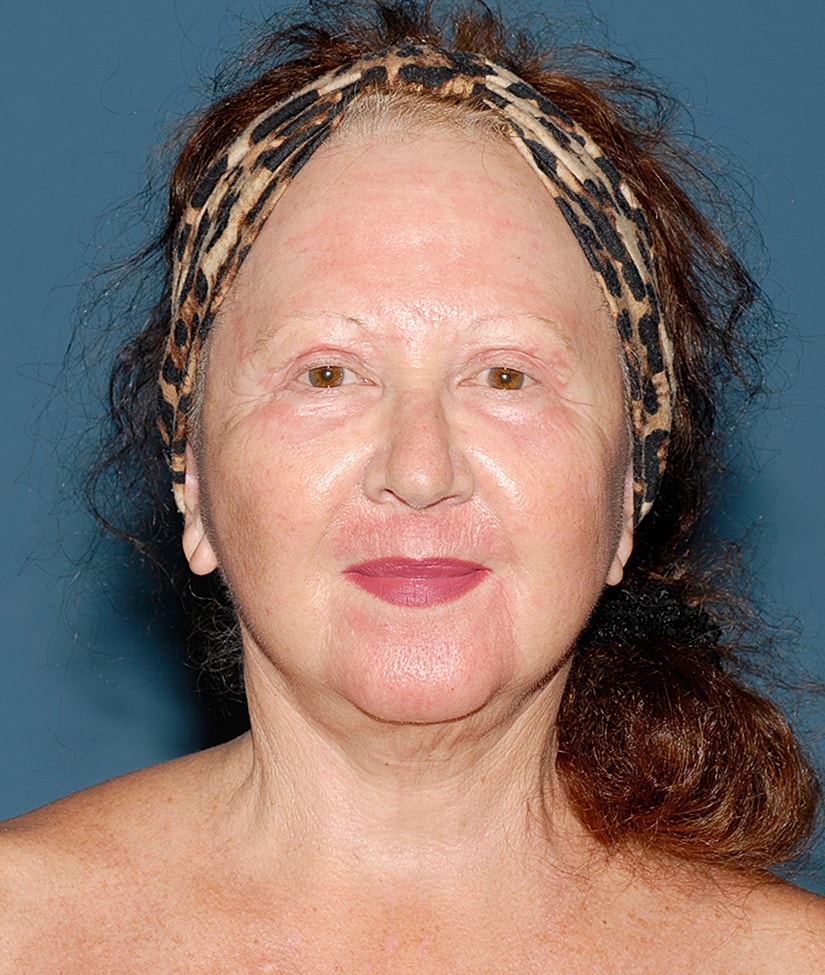 Female Facial Rejuvenation Before & After