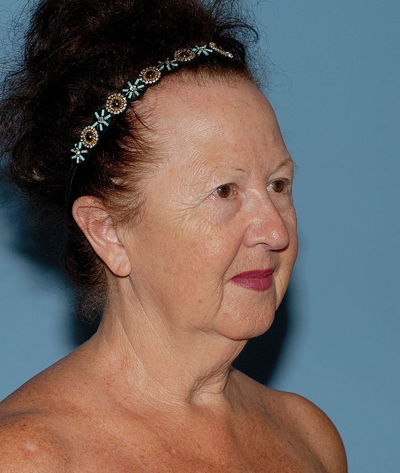Female Facial Rejuvenation Before & After