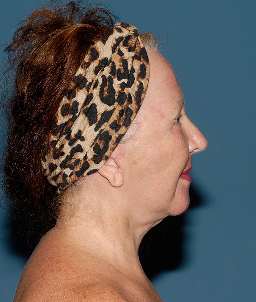 Female Facial Rejuvenation Before & After