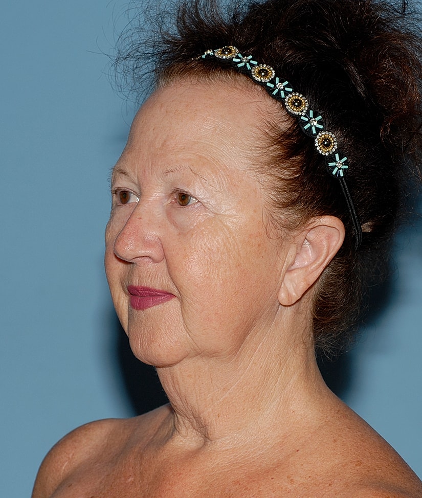 Female Facial Rejuvenation Before & After