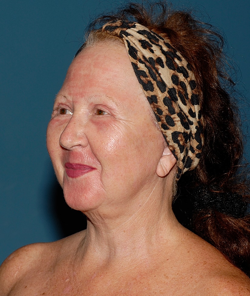 Female Facial Rejuvenation Before & After