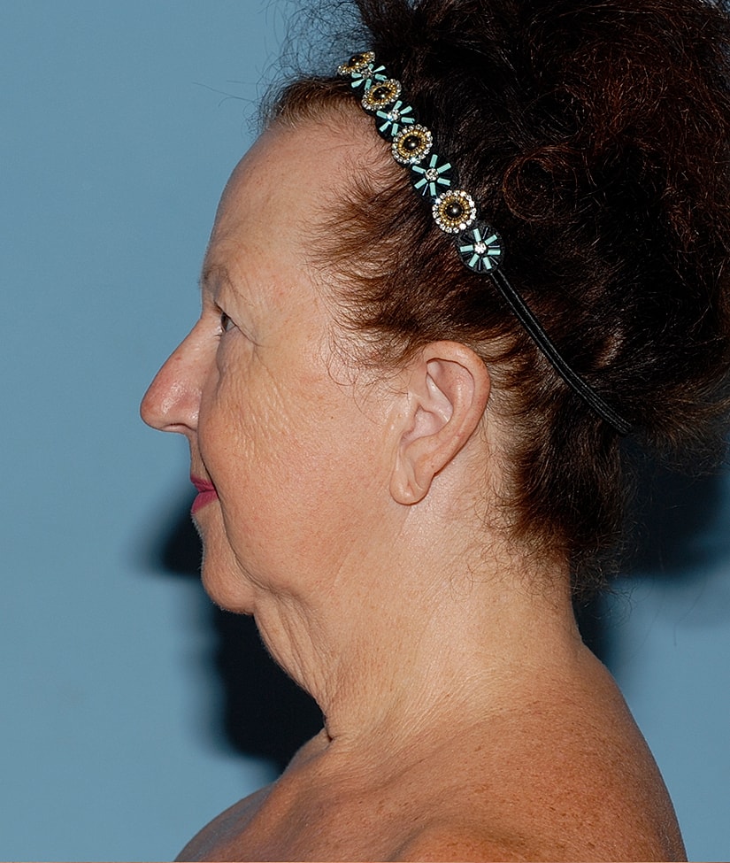 Female Facial Rejuvenation Before & After