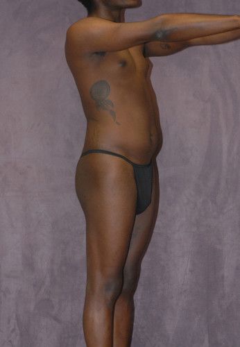 Male To Female Body Contouring Before & After