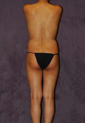 Male To Female Body Contouring Before & After