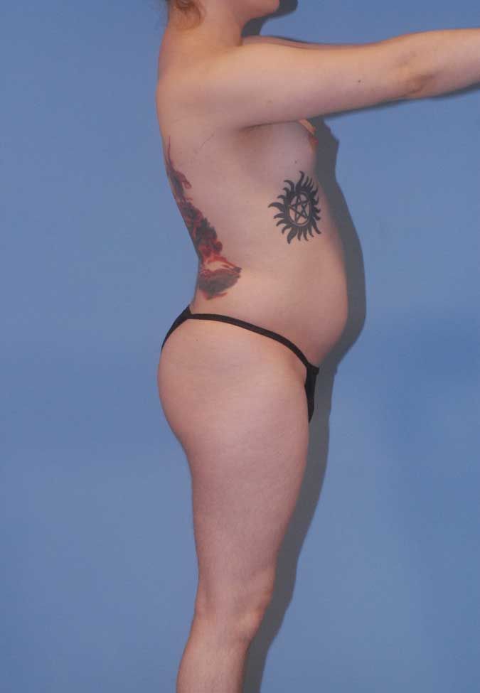 Male To Female Body Contouring Before & After