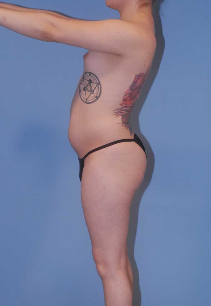 Male To Female Body Contouring Before & After