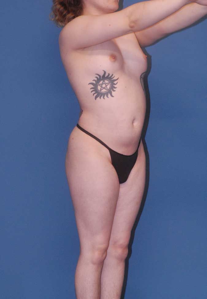 Male To Female Body Contouring Before & After