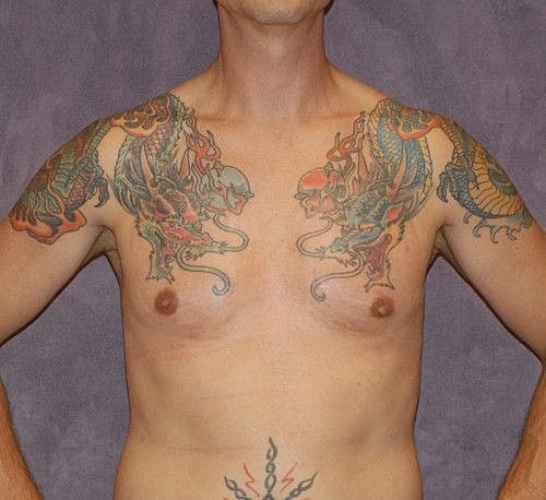 Male To Female Body Contouring Before & After