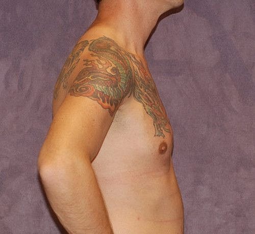 Male To Female Body Contouring Before & After