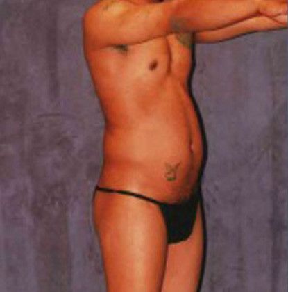 Male Body Contouring Before & After