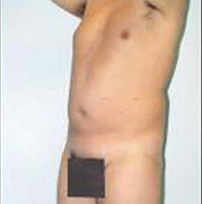 Male Body Contouring Before & After