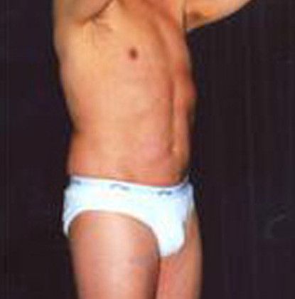 Male Body Contouring Before & After