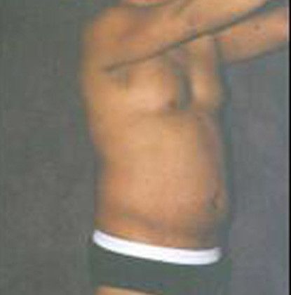 Male Body Contouring Before & After