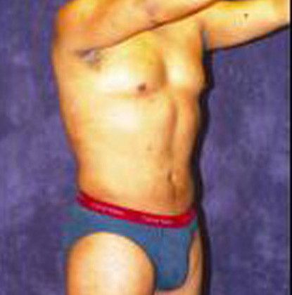 Male Body Contouring Before & After