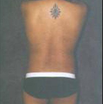 Male Body Contouring Before & After