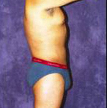 Male Body Contouring Before & After