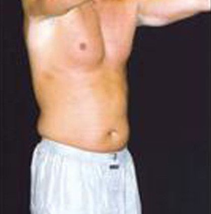 Male Body Contouring Before & After