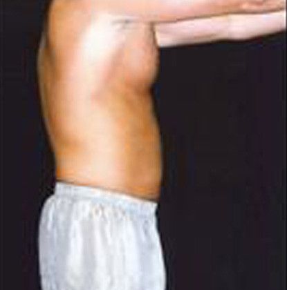 Male Body Contouring Before & After