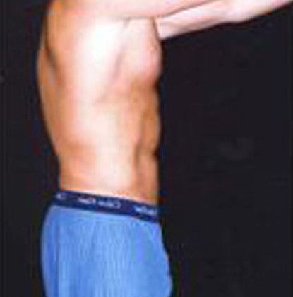 Male Body Contouring Before & After