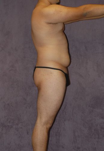 Male Body Contouring Before & After